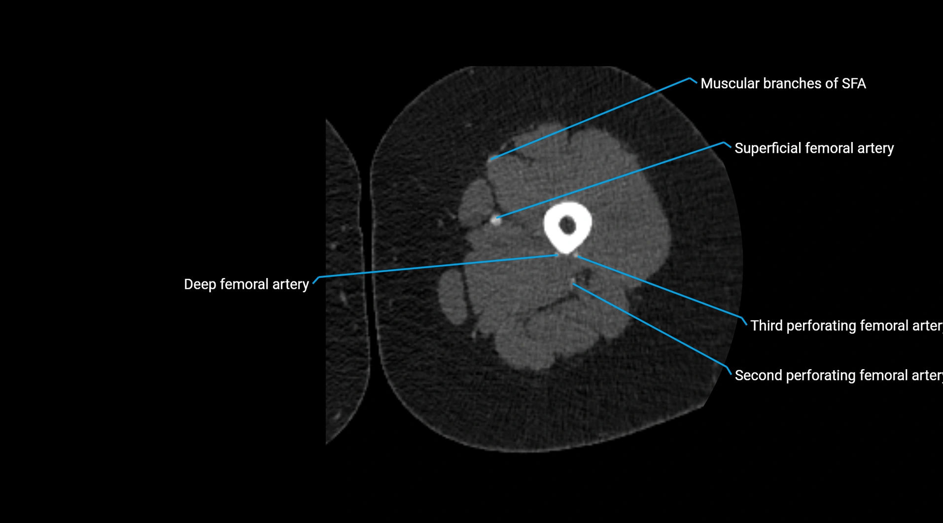 CTA lower limb cross sectional anatomy labelled image _119.webp